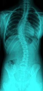 scoliosis